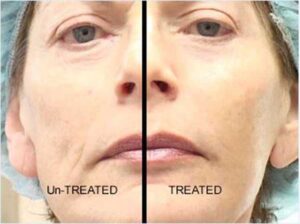 stem cells anti-aging therapy