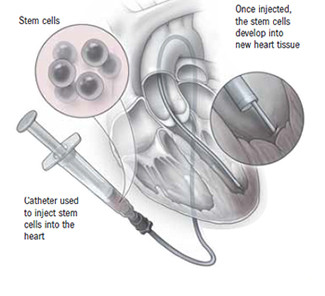 The image show stem cell Therapy for heart.