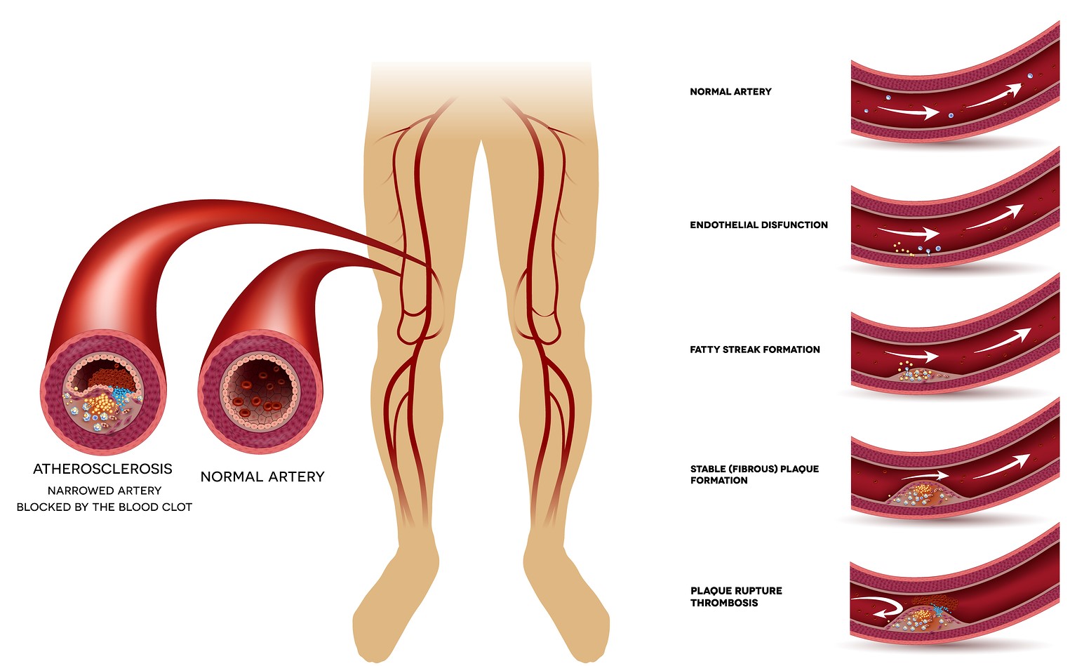 Treating Peripheral Artery Disease by Stem Cells