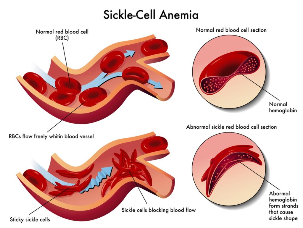 Stem cell treatment for sickle cell anemia